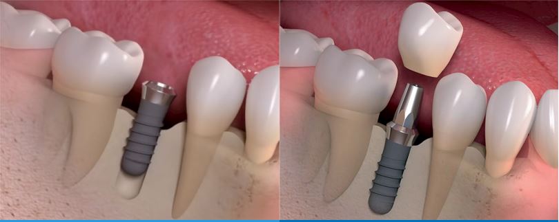 trồng răng implant