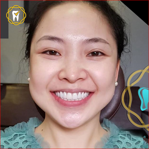 Khách hàng cấy ghép implant và bọc sứ cao cấp